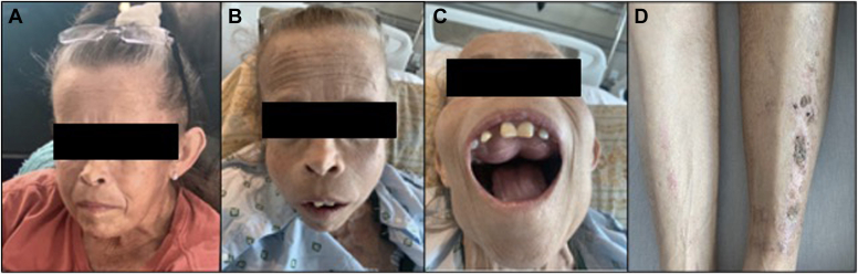 Uremic Leontiasis Ossea due to Resistant Secondary Hyperparathyroidism