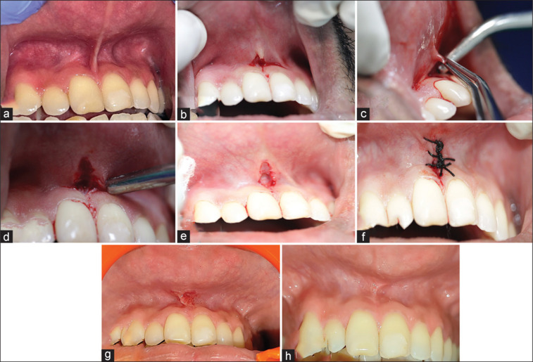Evaluation of esthetics, pain scores, and prognosis of modified paralleling technique for high frenal attachment: A case series.