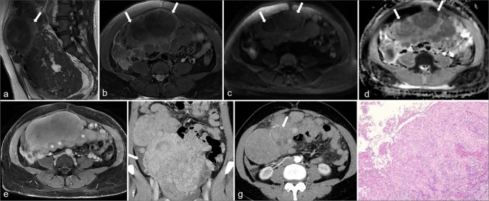 Computed tomography and magnetic resonance imaging features of abdominal and pelvic leiomyomatosis peritonealis disseminata: A retrospective observational study.