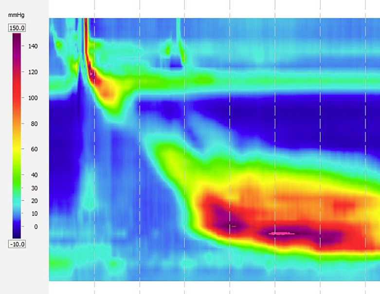Jackhammer Esophagus as a Complication of Tonsillectomy and Adenoidectomy: A Case Report.