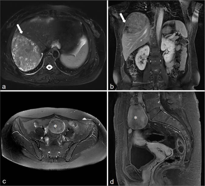 Computed tomography and magnetic resonance imaging features of abdominal and pelvic leiomyomatosis peritonealis disseminata: A retrospective observational study.