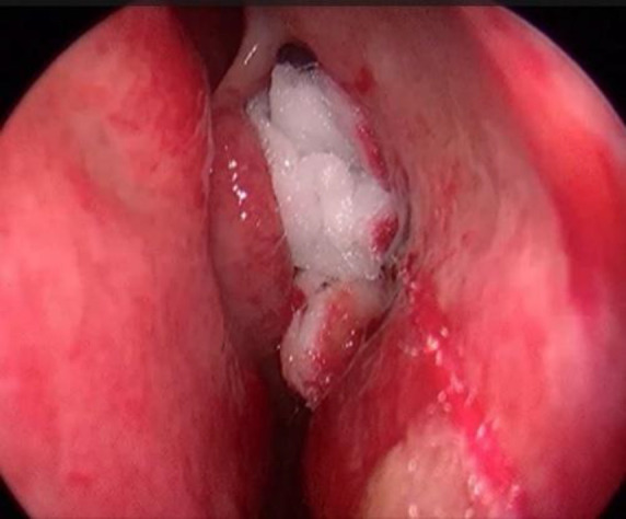 Effect of Intra-Operative Topical 5-Fluorouracil Post-Functional Endoscopic Sinus Surgery: A Randomized Controlled Trial.