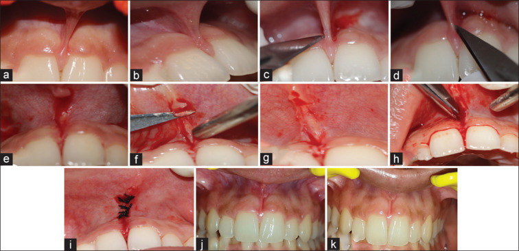 Evaluation of esthetics, pain scores, and prognosis of modified paralleling technique for high frenal attachment: A case series.