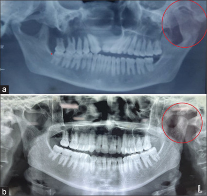 Osteochondroma of the condyle of the mandible: A case report.