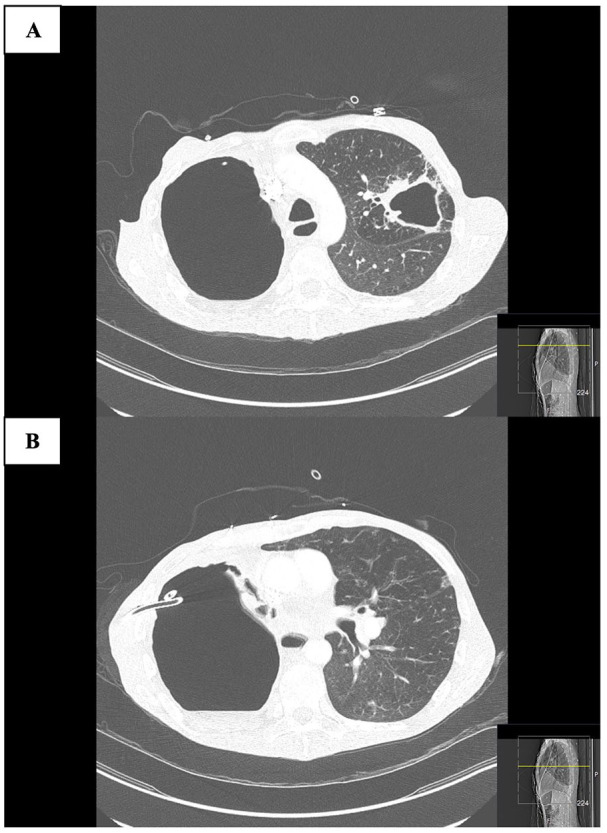 Concurrent Coccidioidomycosis and <i>Mycobacterium abscessus</i> Infection in Chronic Obstructive Pulmonary Disease.