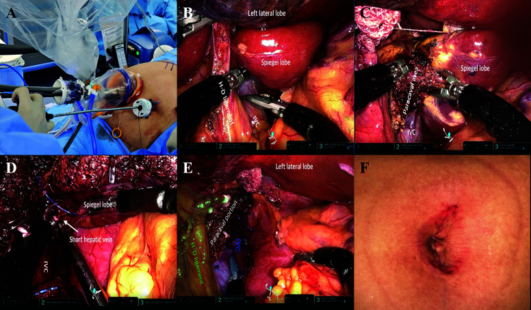 Robotic Caudate Lobectomy: Feasibility and Techniques with Da Vinci Xi and SP Systems.