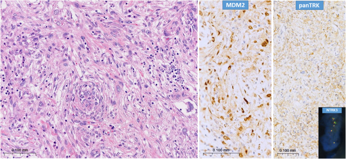 NTRK amplification occurs frequently in pan-TRK immunopositive dedifferentiated liposarcomas.