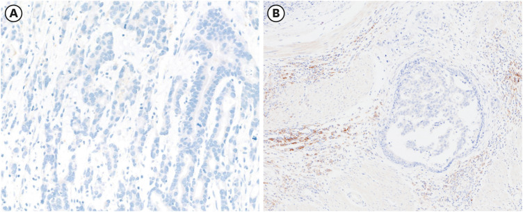 PD-L1 as a Biomarker in Gastric Cancer Immunotherapy.