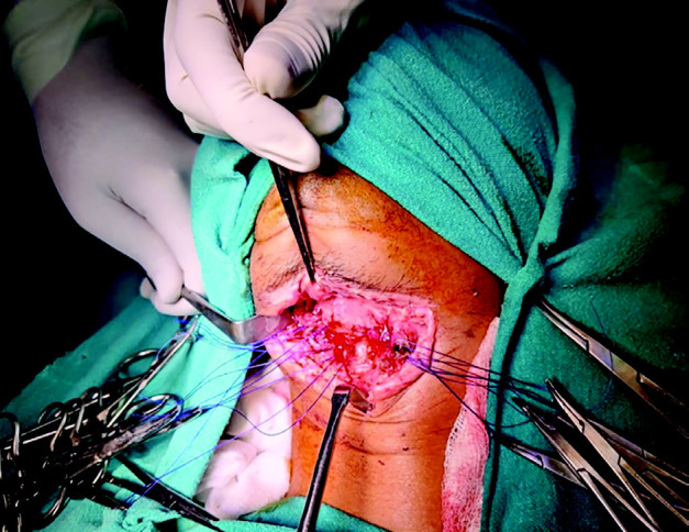 Self-Inflicted Cut-Throat Injuries in Psychiatric Patients During the COVID-19 Pandemic: A Report of Two Rare Cases.