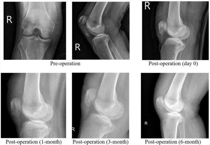 A Novel Transosseous Suture Repair Technique for Inferior Pole Patella Fractures Using a Suture Anchor: A Case Series and Technical Note.