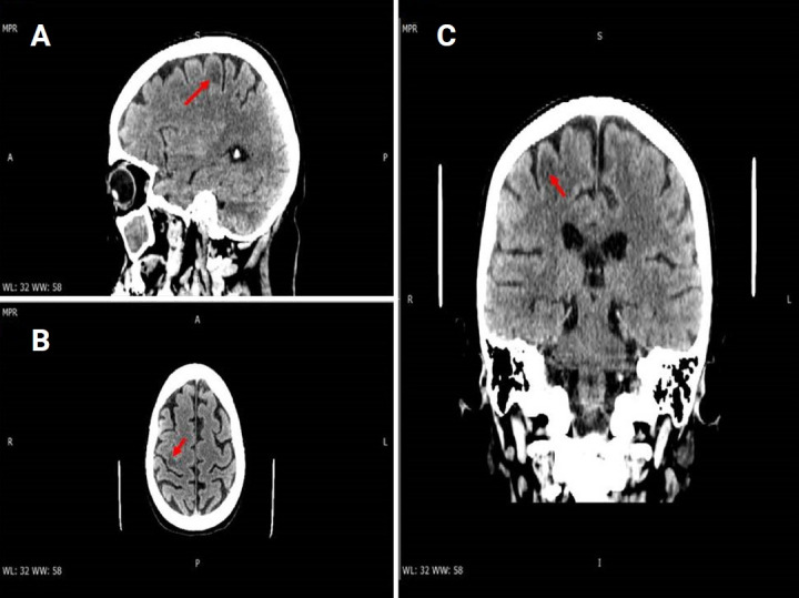 Progressive multifocal leukoencephalopathy, the role of the susceptibility-weighted imaging sequence in a case of immunosuppression of an initially unknown cause.
