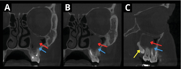 Revascularization of an Autotransplanted Mature Tooth After Extraoral Root Resection: A Case Report.