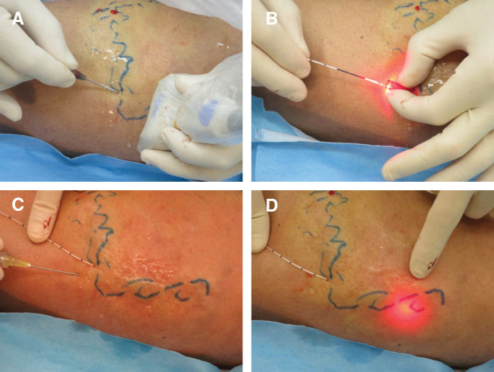 Supplement of Clinical Practice Guidelines for Endovenous Thermal Ablation for Varicose Veins 2019: Laser Ablation of Varicose Tributaries.