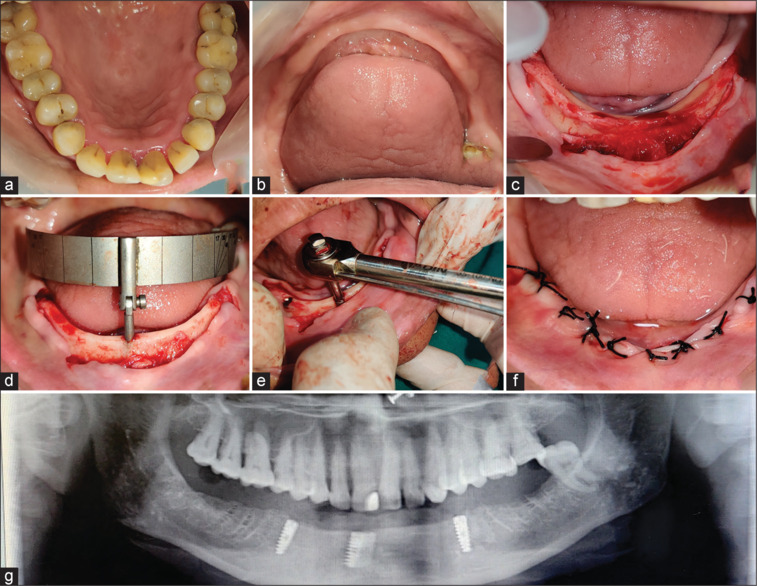Prosthodontic rehabilitation of resorbed mandibular ridges using guided all-on-four technique and implant retained overdentures-A case series.