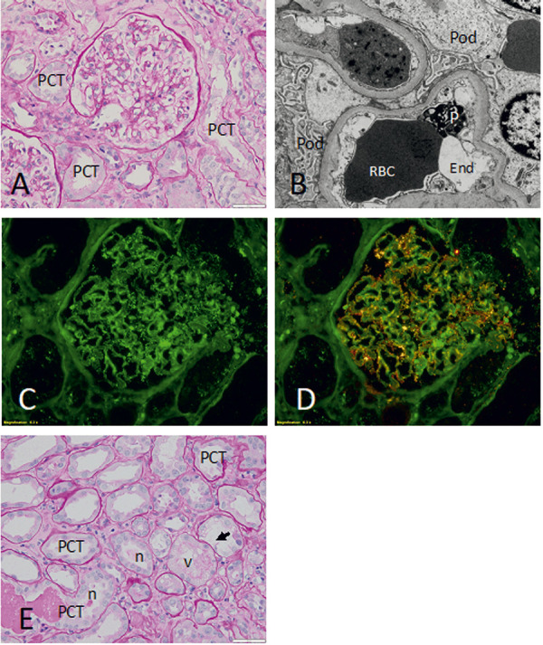 Minimal change disease in treatment-naïve hepatitis C virus infection: A case report and literature review.