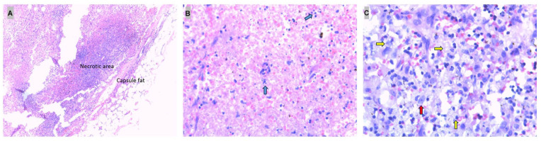 Case Report: Two Cases of Kikuchi Disease in West Texas With Non-Self-Limited Disease.