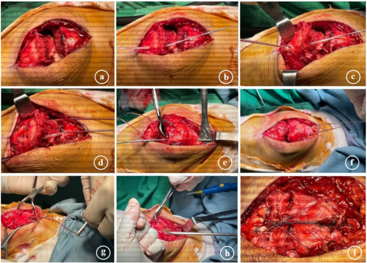 A Novel Transosseous Suture Repair Technique for Inferior Pole Patella Fractures Using a Suture Anchor: A Case Series and Technical Note.