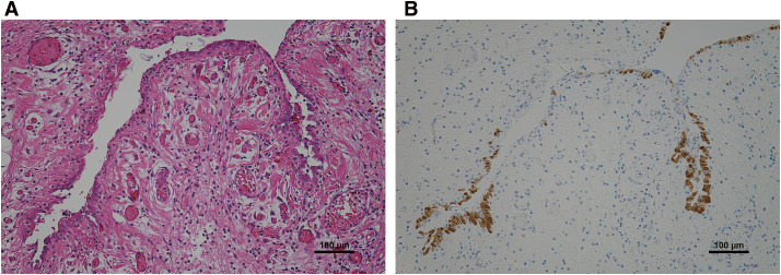 Benign Cystic Mesothelioma of the Peritoneum Arising at the Greater Omentum in a 14-Year-Old Boy.