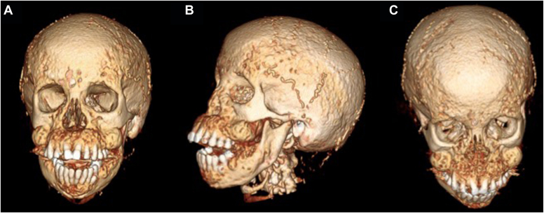 Uremic Leontiasis Ossea due to Resistant Secondary Hyperparathyroidism