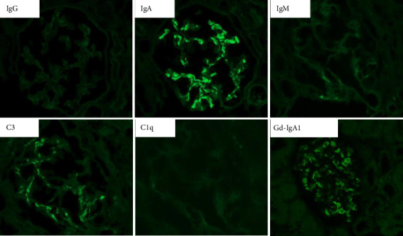 A Case of IgA Nephropathy in a Patient With Sarcoidosis: Confirmation of Glomerular Galactose-Deficient IgA1 Deposition.