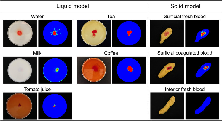 Possibility of determining high quantitative fecal occult blood on stool surface using hyperspectral imaging.
