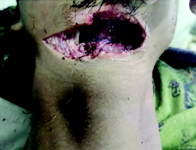Self-Inflicted Cut-Throat Injuries in Psychiatric Patients During the COVID-19 Pandemic: A Report of Two Rare Cases.