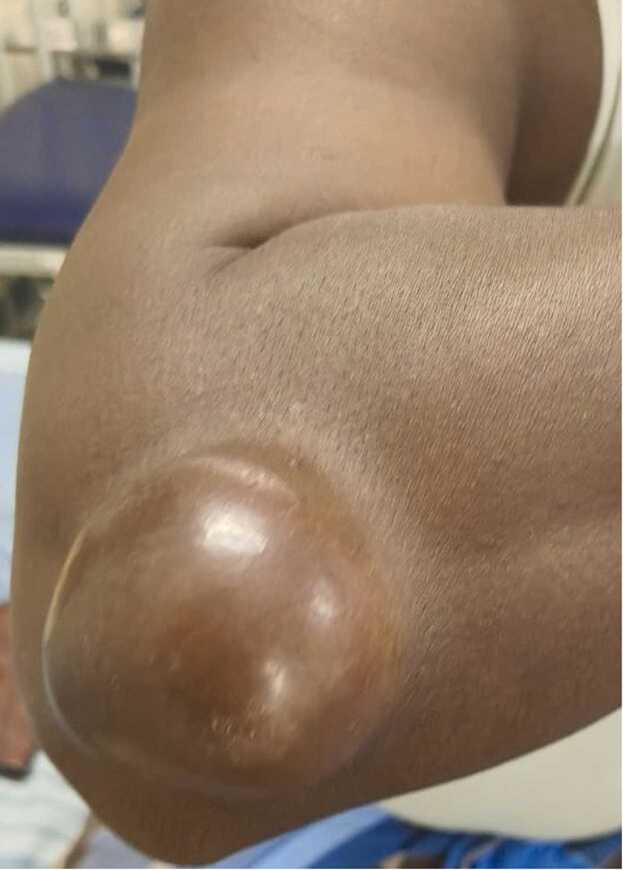 Mycotic cyst: Case report