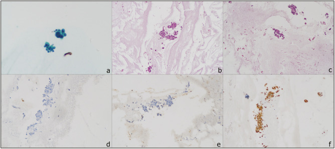 The Role of Immunohistochemistry in Reducing the "Atypia of Undetermined Significance (AUS)" Category in Serous Fluid Cytology.