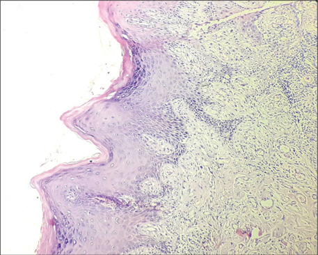 Management of leukoplakia of palatal gingiva using free gingival graft.