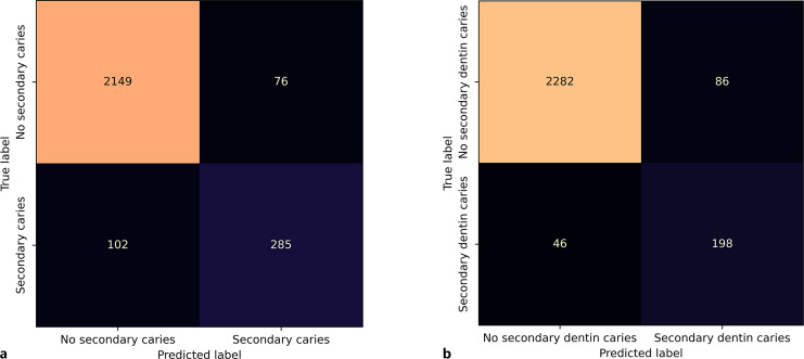 Deep Learning-Based Algorithm for Staging Secondary Caries in Bitewings.