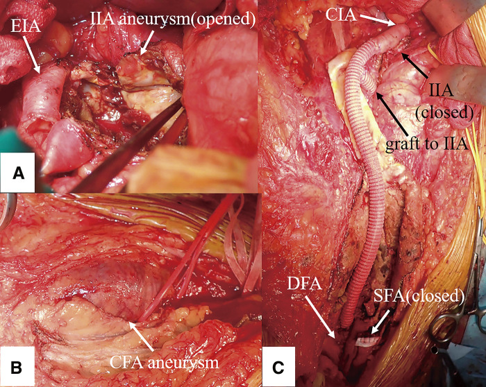 Common Femoral Artery Aneurysm: A Rare Manifestation of Immunoglobulin G4-Related Disease.