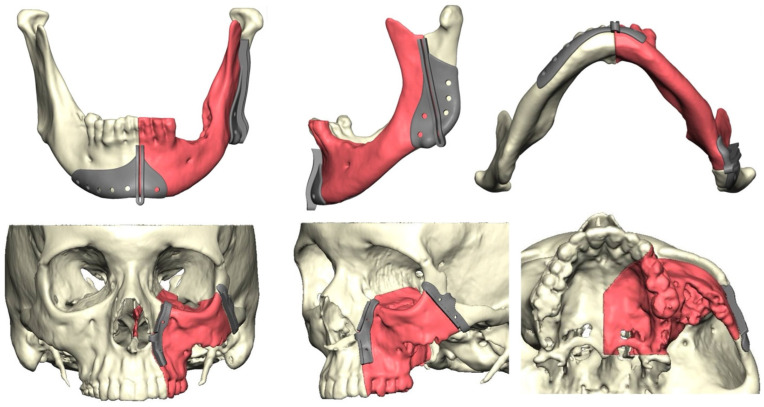 Oncological Outcomes Following Computer-Aided Reconstructive Jaw Surgery.