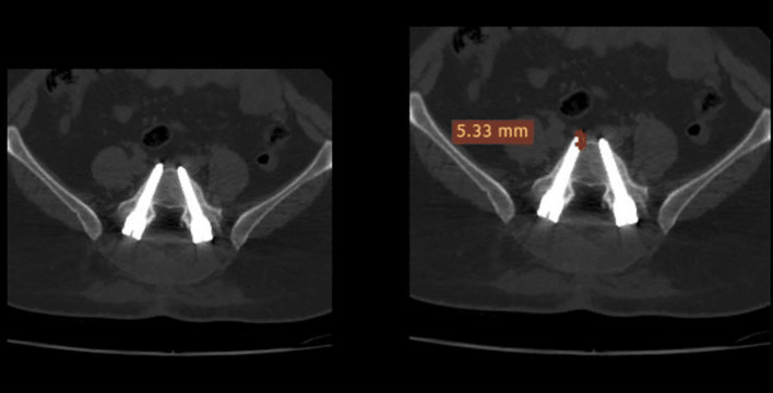 Validity of a new scoring system for assessment and decision guidance of misplaced pedicular screws.