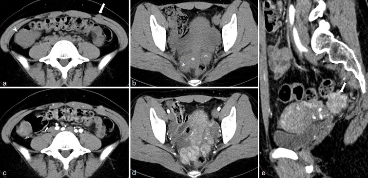 Computed tomography and magnetic resonance imaging features of abdominal and pelvic leiomyomatosis peritonealis disseminata: A retrospective observational study.