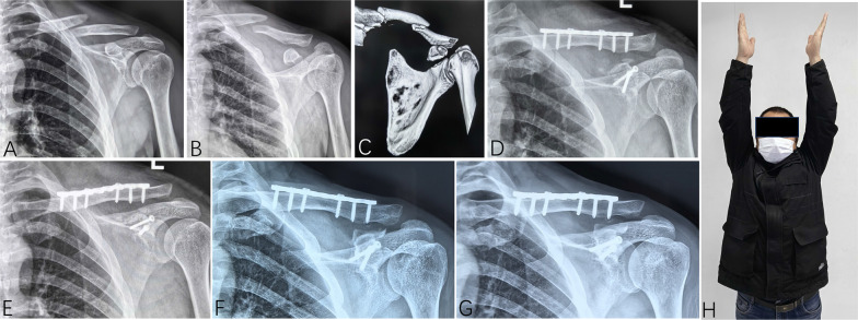 Ipsilateral concomitant fractures of the clavicle and coracoid process of the scapula: incidence, characteristics, and outcomes.