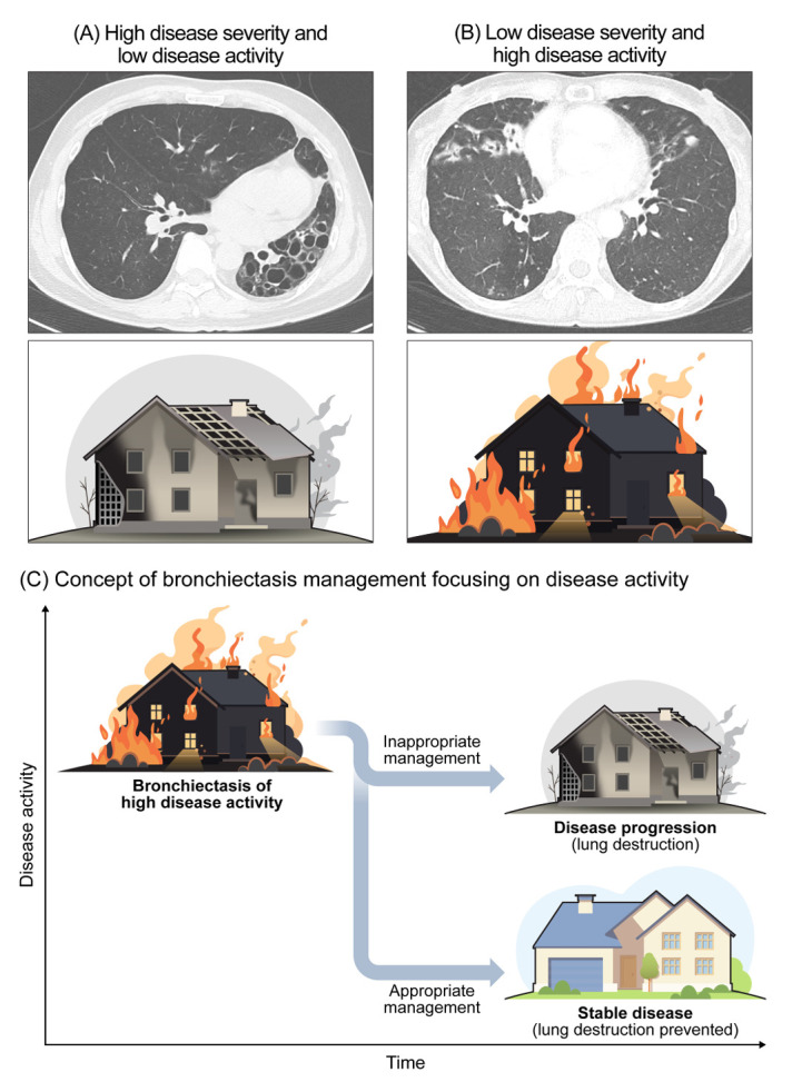 Disease Severity and Activity in Bronchiectasis: A Paradigm Shift in Bronchiectasis Management.