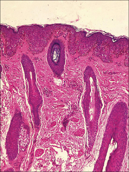 Unilateral Follicular Facial Papules in a Child.