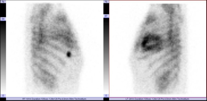 Unexplained Cardiac Uptake on <sup>99m</sup>Tc-MDP Bone Scan in a Patient with Prostate Cancer.