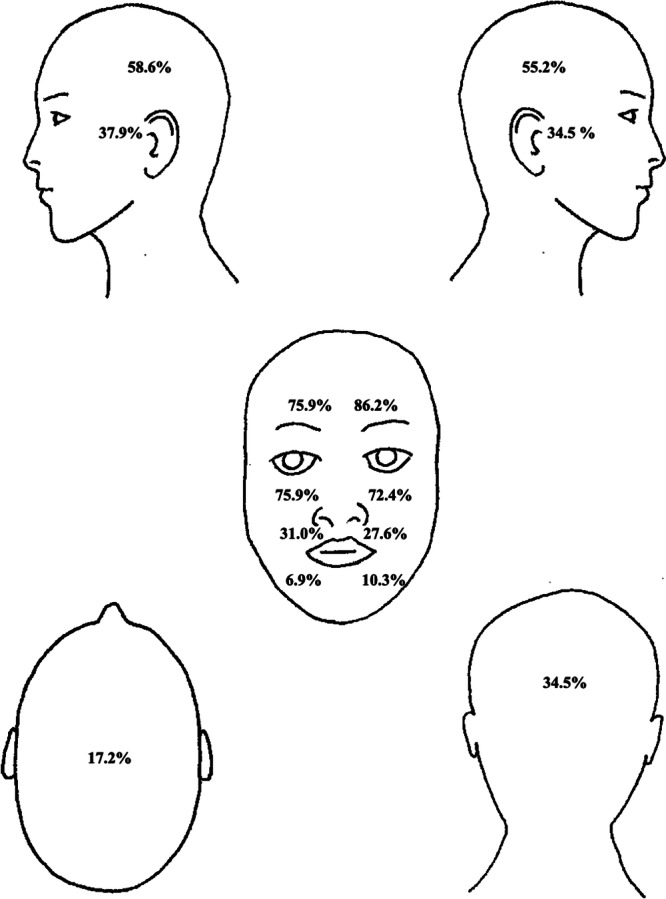 Concurrent Nasal Symptoms in Non-Rhinogenic Headache.