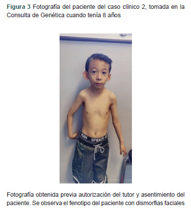 [Ring chromosome 21 syndrome: report of 2 cases].