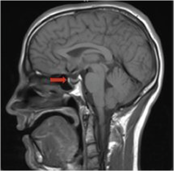 Hypogonadism in a Man With Cystic Fibrosis and an Unusually Low Serum Testosterone: A Cautionary Tale
