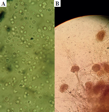 Role of <i>TLR2</i> rs5743708 and dectin-1 rs16910526 polymorphisms in susceptibility to fungal infections in COVID-19 patients.