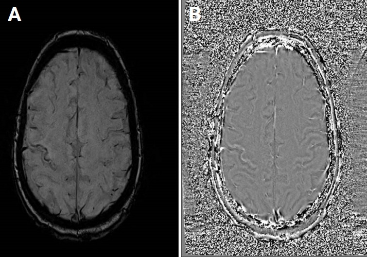 Progressive multifocal leukoencephalopathy, the role of the susceptibility-weighted imaging sequence in a case of immunosuppression of an initially unknown cause.