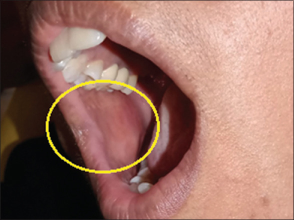 Angioleiomyoma of cheek - A case report highlighting immunohistochemical diagnostic approach.