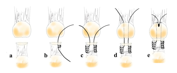 A Novel Transosseous Suture Repair Technique for Inferior Pole Patella Fractures Using a Suture Anchor: A Case Series and Technical Note.