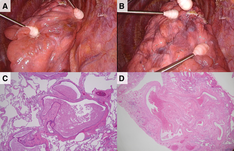 Congenital Pulmonary Airway Malformation with Pulmonary Arteriovenous Malformation in Adulthood: A Case Report.