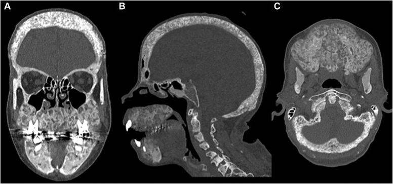 Uremic Leontiasis Ossea due to Resistant Secondary Hyperparathyroidism