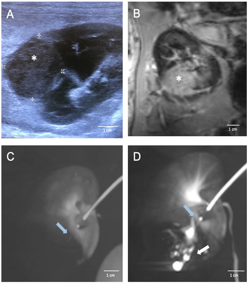 Trans-Vessel Wall Cell Transplantation, Engraftment, and Tumor Access in the VX2 Rabbit Model.