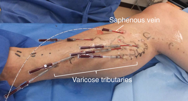 Supplement of Clinical Practice Guidelines for Endovenous Thermal Ablation for Varicose Veins 2019: Laser Ablation of Varicose Tributaries.