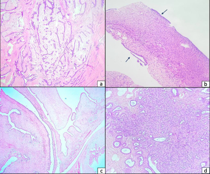 Giant Tubular Adenoma of the Breast in an Adolescent: Diagnostic Challenges and Literature Review.